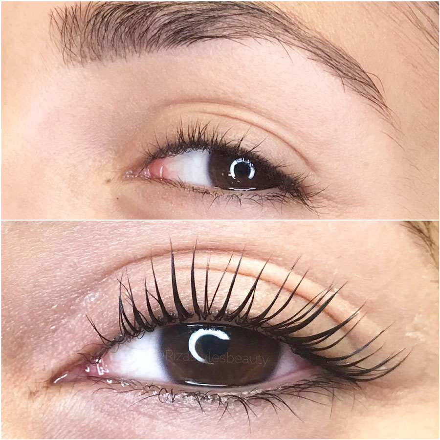 eyelift