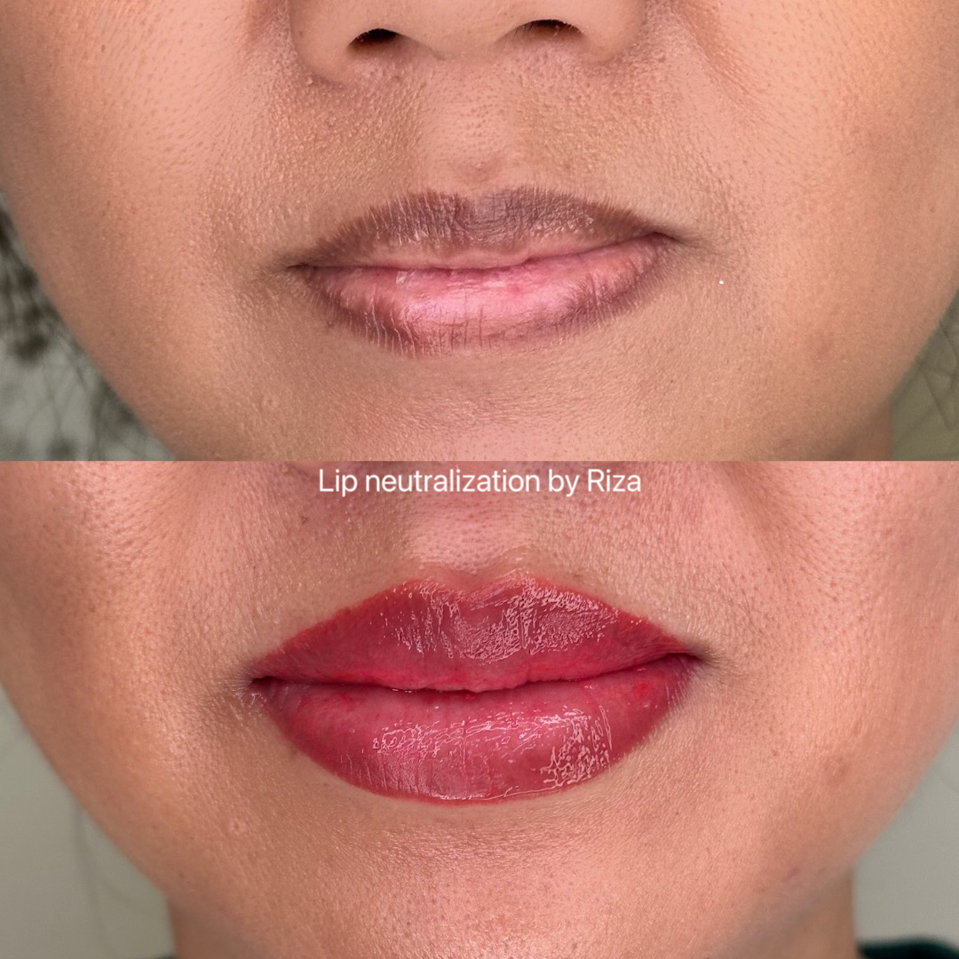 lip neutralization